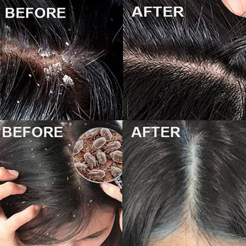 Fast Anti Dandruff Hair Treatm - Scalp Scrub Exfoliant 评论和价格